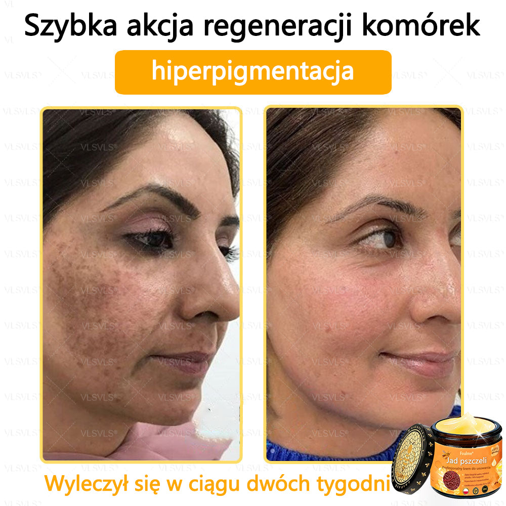 【Oficjalny sklep flagowy】Foulme® Profesjonalny krem do usuwania jadu pszczelego✨