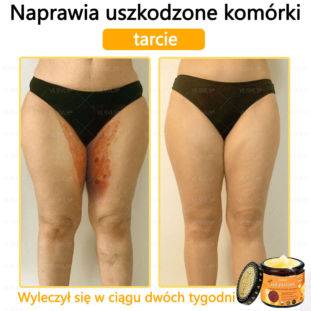 【Oficjalny sklep flagowy】Foulme® Profesjonalny krem do usuwania jadu pszczelego✨