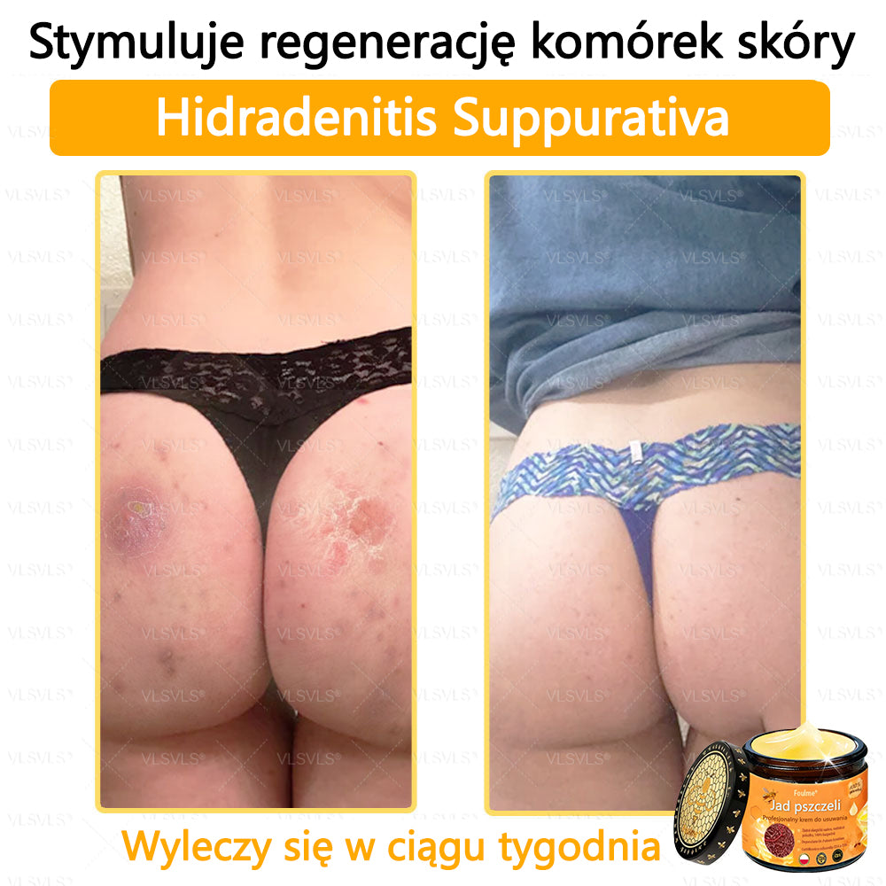 【Oficjalny sklep flagowy】Foulme® Profesjonalny krem do usuwania jadu pszczelego✨
