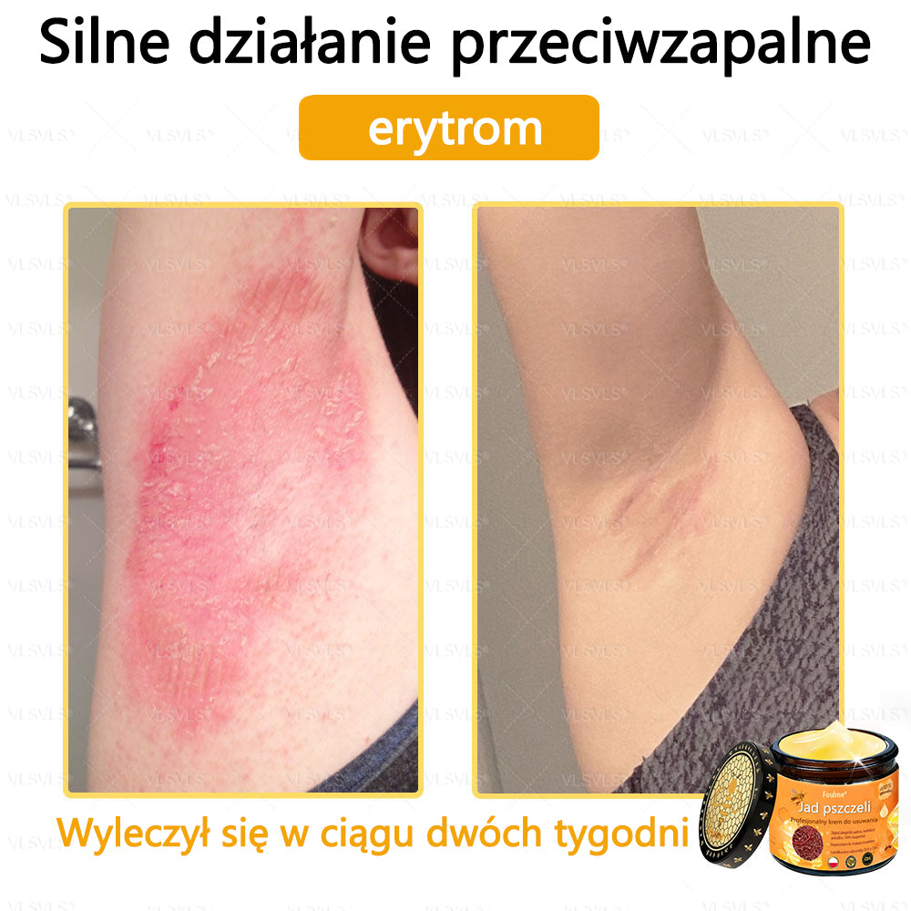 【Oficjalny sklep flagowy】Foulme® Profesjonalny krem do usuwania jadu pszczelego✨
