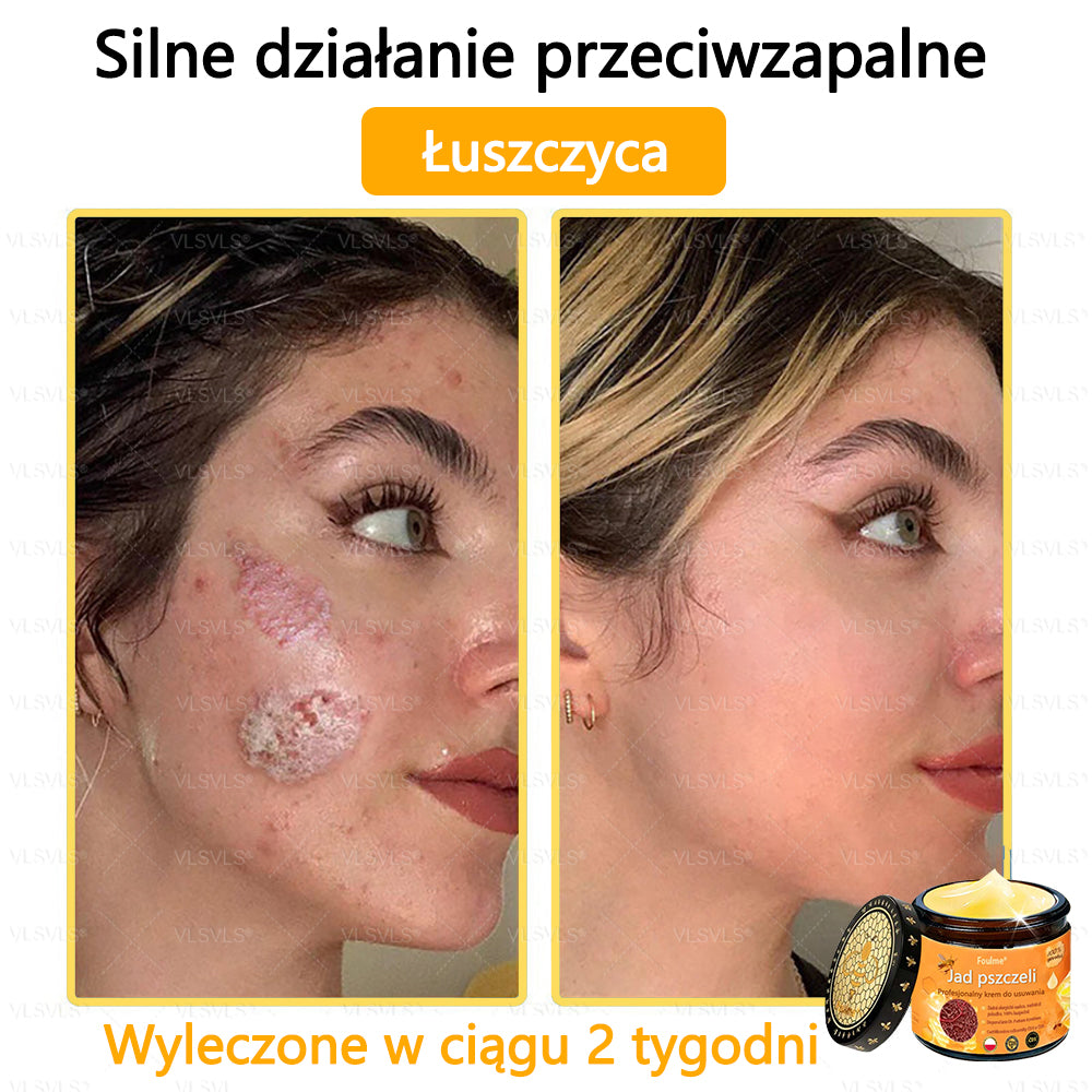【Oficjalny sklep flagowy】Foulme® Profesjonalny krem do usuwania jadu pszczelego✨