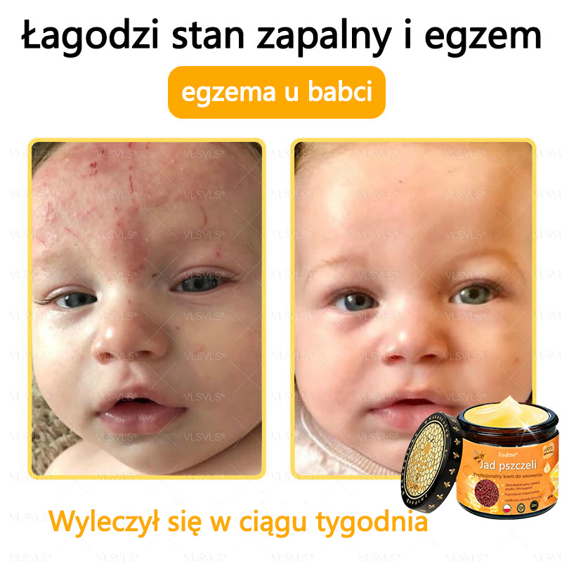【Oficjalny sklep flagowy】Foulme® Profesjonalny krem do usuwania jadu pszczelego✨