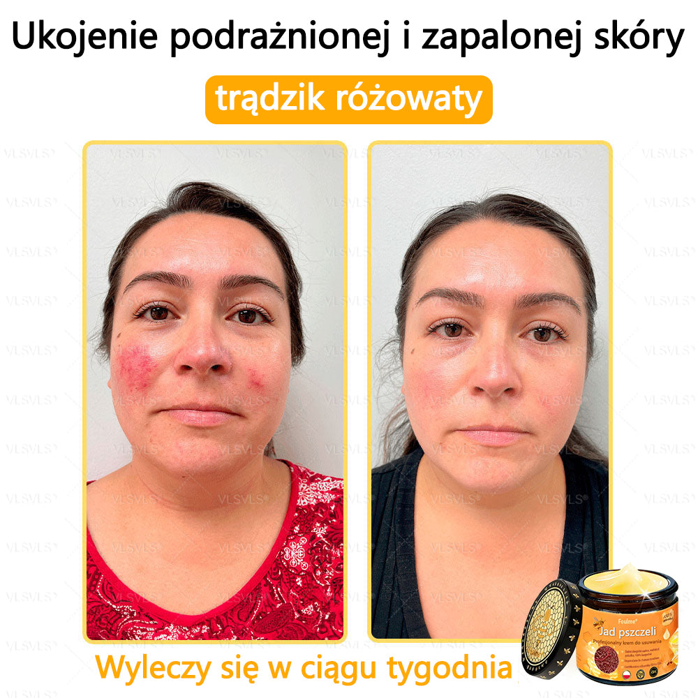 【Oficjalny sklep flagowy】Foulme® Profesjonalny krem do usuwania jadu pszczelego✨