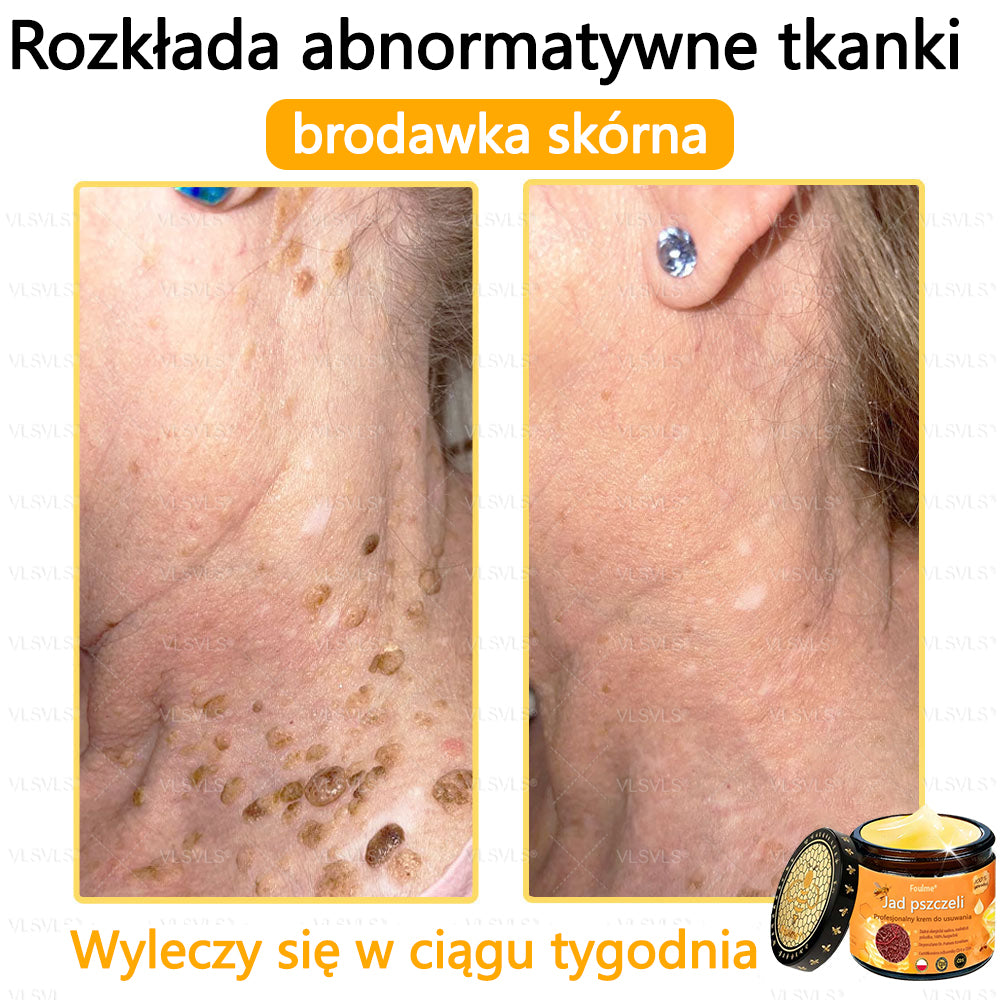 【Oficjalny sklep flagowy】Foulme® Profesjonalny krem do usuwania jadu pszczelego✨