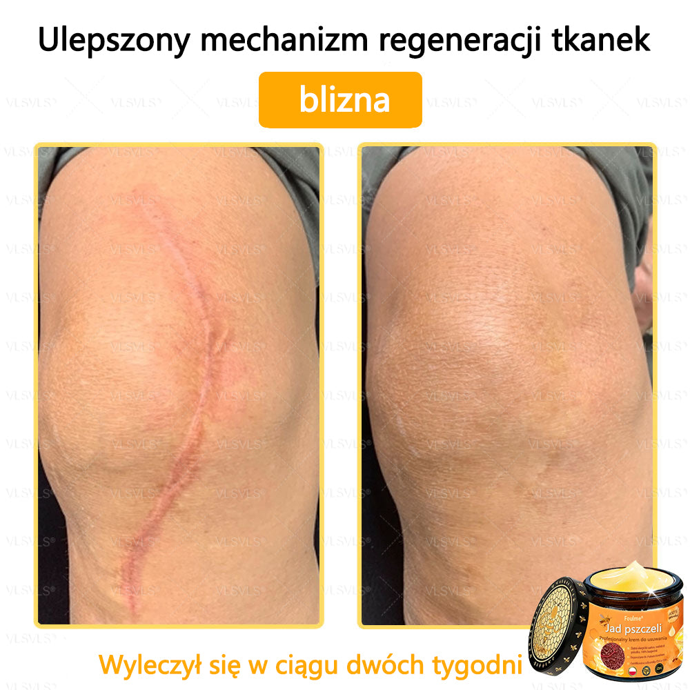 【Oficjalny sklep flagowy】Foulme® Profesjonalny krem do usuwania jadu pszczelego✨