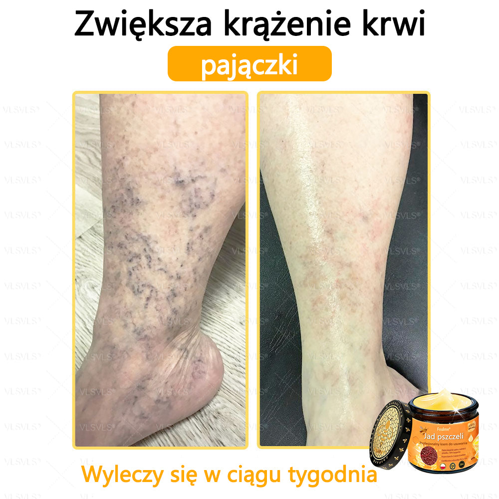 【Oficjalny sklep flagowy】Foulme® Profesjonalny krem do usuwania jadu pszczelego✨