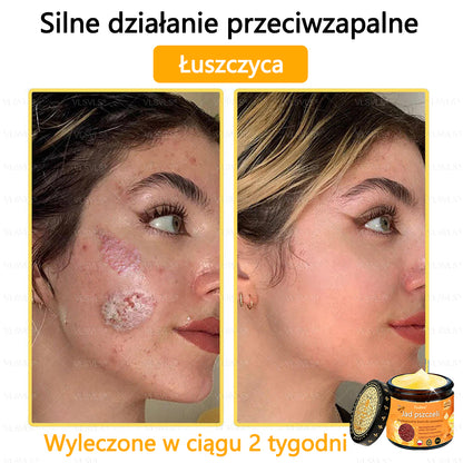 【Oficjalny sklep flagowy】Foulme® Profesjonalny krem do usuwania jadu pszczelego