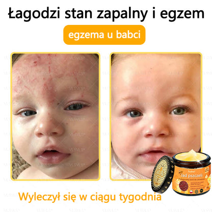 【Oficjalny sklep flagowy】Foulme® Profesjonalny krem do usuwania jadu pszczelego